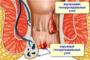 Геморой при вагітності: чим лікувати і як запобігти?