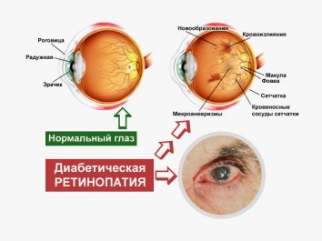 Поражения сосудов глаз