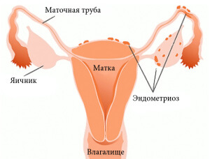 Эндометриоз