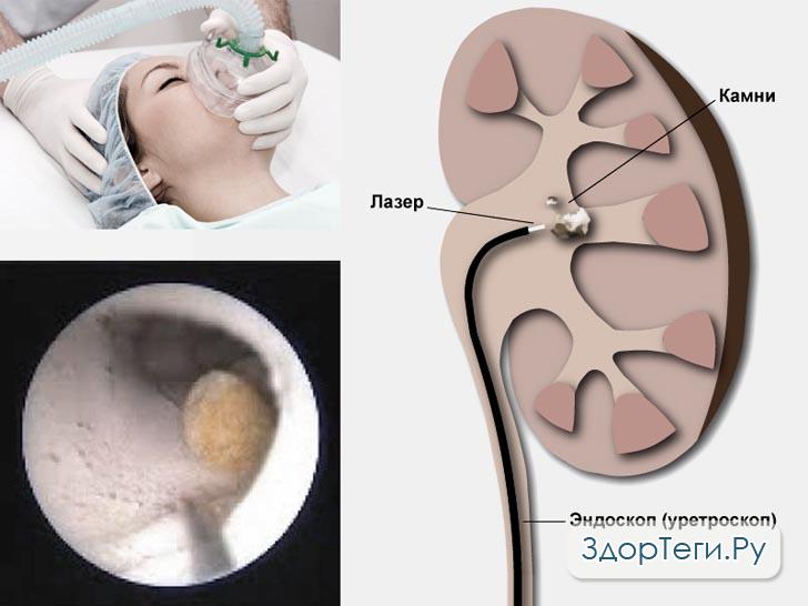 Камни в почках как без операции. Эндоскопические операции камни в почках. Эндоскопическая операция почки. Операция на почки во убиранию камней.