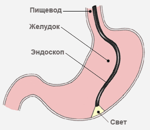 Эндоскоп в желудке