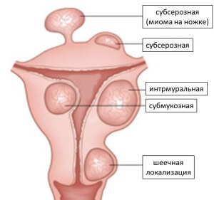 В зависимости от места расположения есть несколько видов фибром