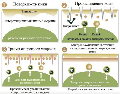 Фракційна мікроігольчатая мезотерапія особи в салоні і вдома