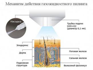 Что такое газожидкостный пилинг лица