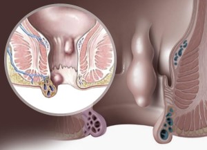 Иллюстрация геморроя