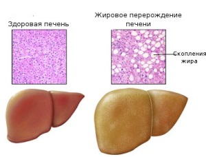 Гепатоз вагітних: що не запустити захворювання і запобігти його прогресування?