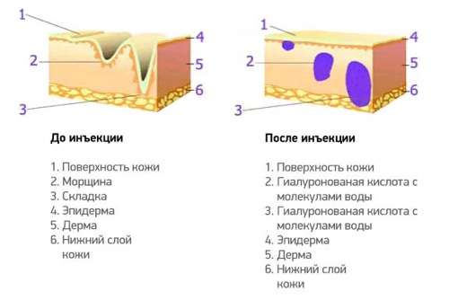 Гіалуронова кислота для обличчя: як застосовувати в домашніх умовах і які процедури зробити в салоні