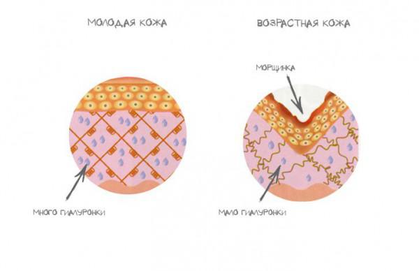 Что лучше ботокс или гиалуроновая кислота