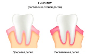 Як запобігти і вилікувати гінгівіт при вагітності?