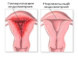 Гіперплазія ендометрію і вагітність: лікування перед зачаттям необхідно!