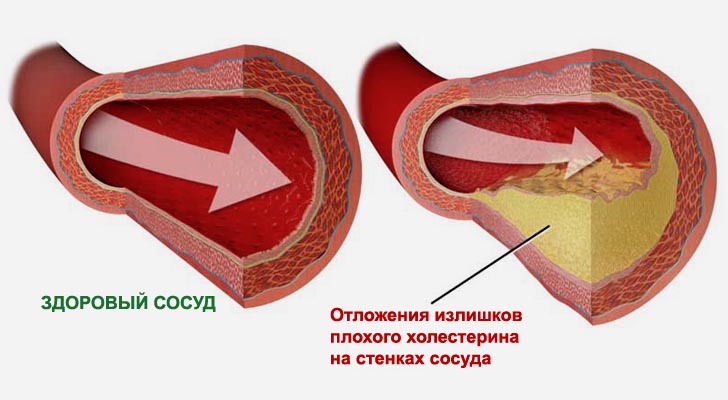 Постепенная закупорка сосуда холестерином