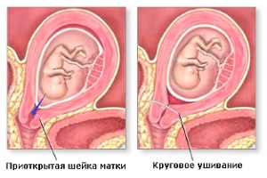 Істміко-цервікальна недостатність: одна з підступних причин викидня