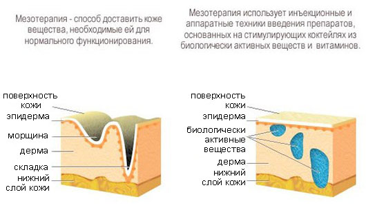 Все про мезотерапії особи - плюси, мінуси та нюанси процедури