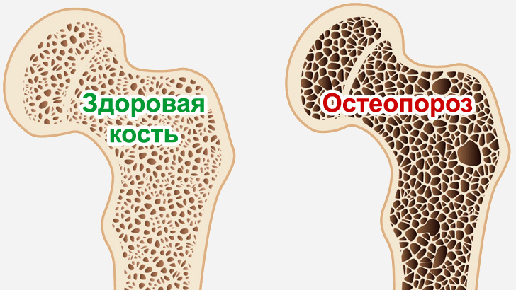 Структура костей, пораженных остеопорозом