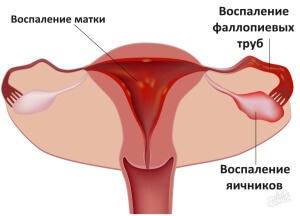 При первых симптомах заболевания следует обратиться к врачу