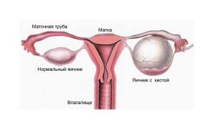 Причиной увеличения яичника может быть киста