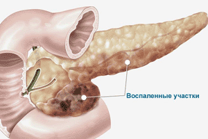 Воспаление поджелудочной
