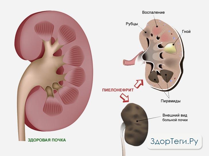 Почки, пораженные пиелонефритом