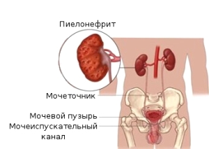 Гестаційний пієлонефрит вагітних: причини, лікування і профілактика захворювання