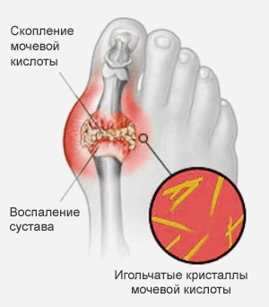 Схема подагрического артрита