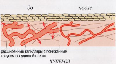 Лікування купероза на обличчі: салонні процедури і народні засоби