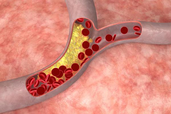 Як знизити холестерин в крові