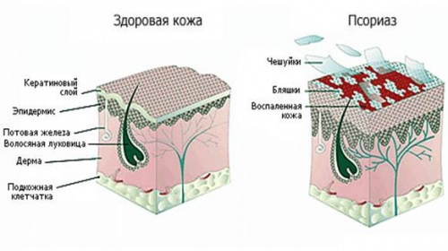 Псоріаз на обличчі хвороба або випробування, як і чим його лікувати в домашніх умовах