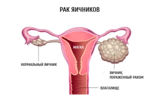 Симптомы и причины рака яичников у женщин