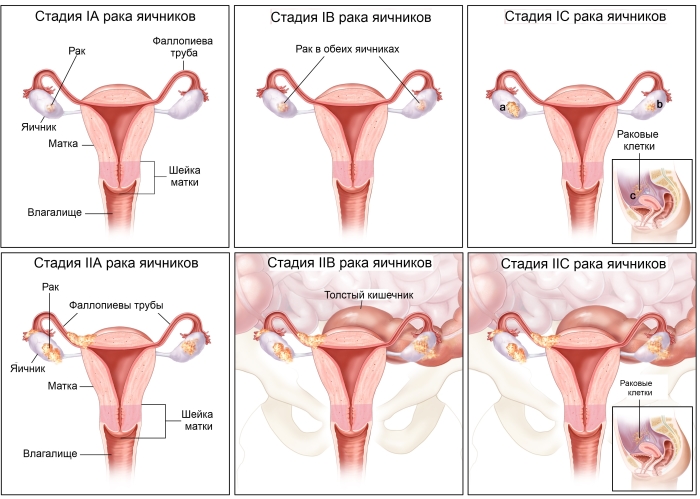 Основные симптомы рака яичников у женщин: четыре стадии заболевания