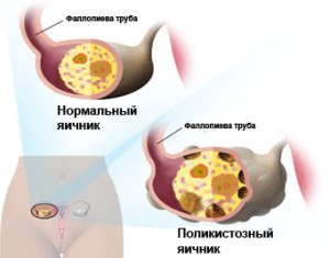 Поликистоз схема