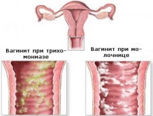 Трихомониаз