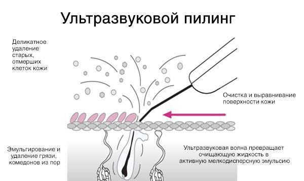 Ультразвуковой пилинг лица что это такое