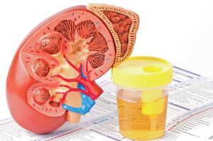 Изменение цветв мочи - первый симптом нарушения в работе почек