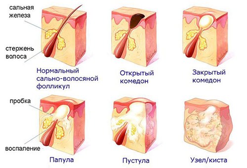 Як позбутися від вугрів на обличчі в домашніх умовах і салоні: огляд методів, засобів, препаратів