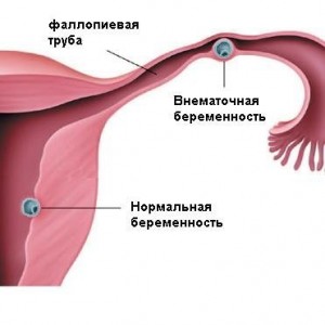 Маточная и внематочная беременность