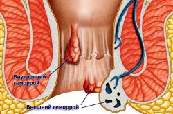 Геморрой после родов - опасное заболевание