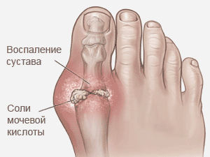 Воспаления при подагре