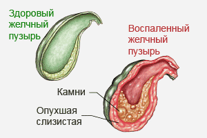 Здоровый и воспаленный желчный пузырь