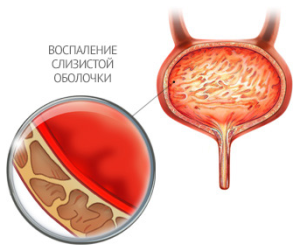 Причины воспаления мочевого пузыря у женщин