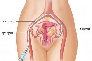 Процедура эмболизации маточных артерий как альтернативный способ лечения миомы