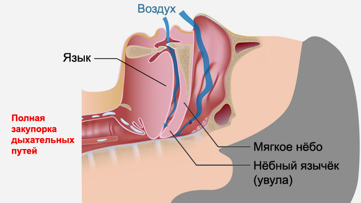 Полная закупорка дыхательных путей во сне